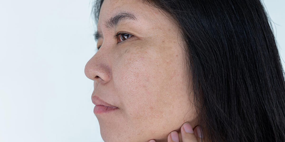 Pigmentation Treatment Puchong