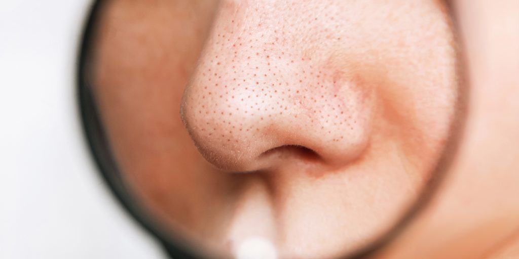 黑头白头怎么清