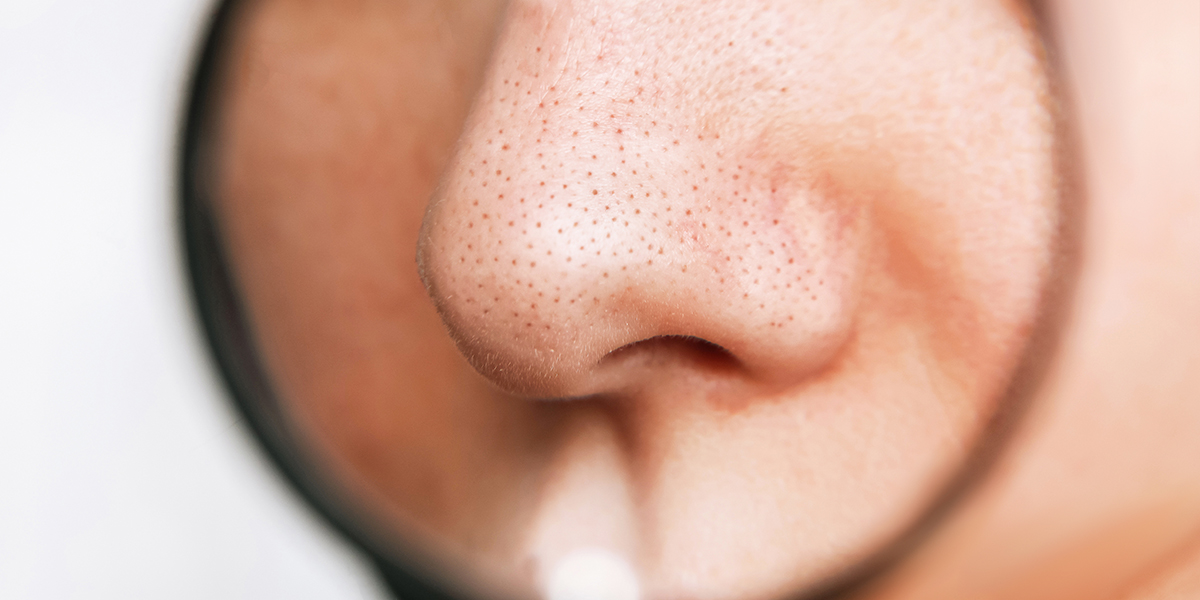 黑头白头怎么清