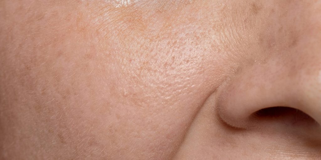 黑头白头怎么清