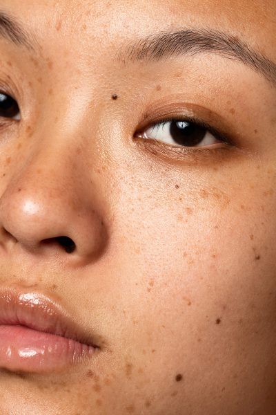 Pigmentation Treatment Puchong